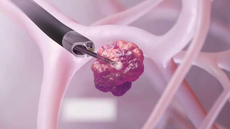 Galaxy reaching a lung nodule to be removed