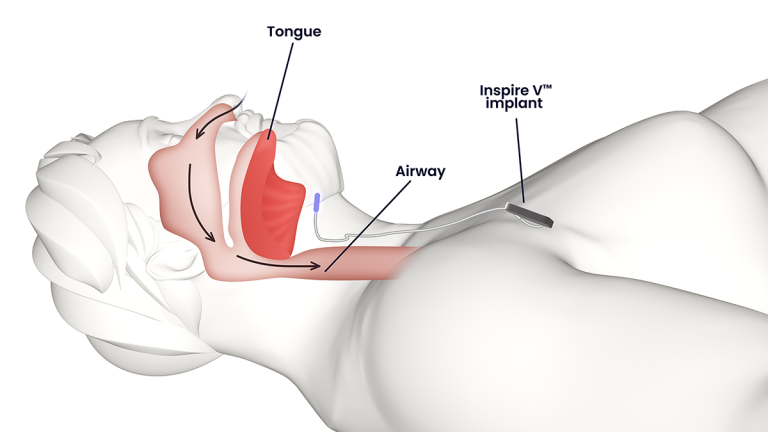 Illustration showing open airway of sleeping person with Inspire implant