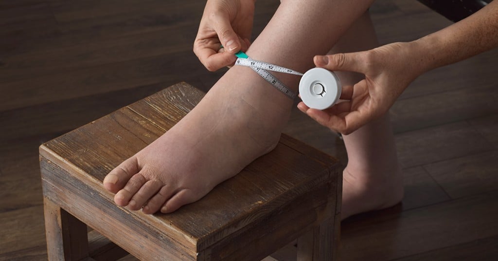 A person with lymphedema measuring the swollen area of their leg